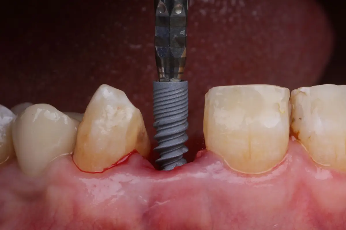 A healed implant in the aesthetic zone