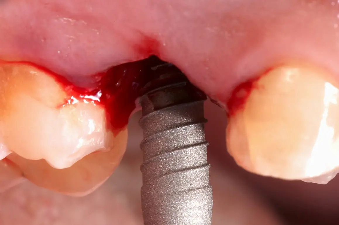 An implant placed between two natural teeth, seen during surgery