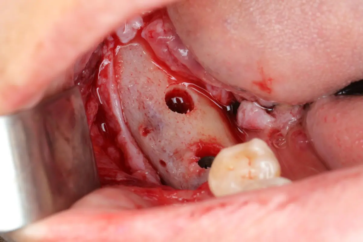 A surgical site during an implant placement on a real patient